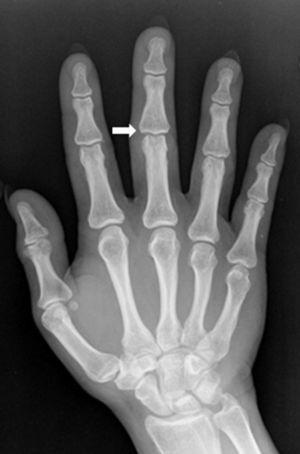 Anteroposterior radiograph at 2 months follow-up demonstrating resolution of the calcified lesion (arrow).