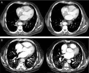 Evolución de la afectación pulmonar mediante tomografía axial computarizada (TAC). (A) La TAC de tórax al diagnóstico reveló la presencia de discretos infiltrados intersticiales en vidrio deslustrado en las bases y la periferia de los pulmones y, en menor medida, en los campos medios, con ganglios linfáticos mediastínicos múltiples de menos de 17mm y atelectasia segmentaria del lóbulo inferior derecho. (B) A los 3 meses la angioTAC no mostró imágenes de tromboembolismo pulmonar, pero sí se observaba una extensa afectación pulmonar bilateral con infiltrados intersticiales con opacidad en vidrio deslustrado y engrosamiento de los septos interlobulillares, así como áreas de fibrosis, estando más respetados los campos pulmonares anteriores.