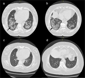 (a, b) Extensive bilateral pulmonary patchy fluffy infiltrates are seen with air alveologram seen within the lower lung lobes are mostly involved; (c, d) complete resolution of lung infiltrates after one month of treatment.