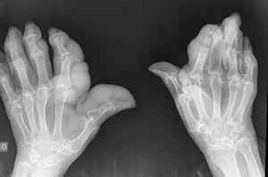 Radiografía de manos: aumento de partes blandas y erosiones.