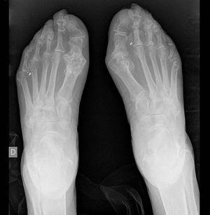 Radiografía de pies: erosiones en primeras metatarsofalángicas.