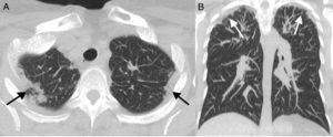 A) TCAR pulmonar corte transversal. B) TCAR pulmonar corte coronal. En ambos cortes se observa la presencia de consolidaciones subpleurales y engrosamiento pleural de predominio apical bilateral.