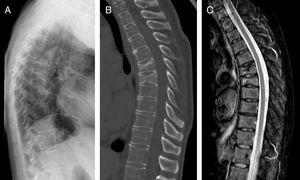Imágenes de las fracturas vertebrales en D6 y D7 del caso 10. Radiografía simple de columna dorsal lateral (A). Corte sagital de TC de columna dorsal (B). RM de columna dorsal en secuencia T2-STIR (C).