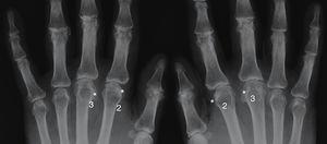 Radiografía AP de manos mostrando cambios degenerativos severos en un paciente con hemocromatosis hereditaria. Se pueden observar como los cambios son más agresivos en la 2.ª y 3.ª metacarpofalángicas de forma bilateral con disminución del espacio articular, esclerosis subcondral y osteofitos en gancho en la zona radial (*).
