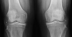 Radiografía AP de rodillas. Muestra condrocalcinosis radiológica (*), disminución del espacio articular, esclerosis subcondral y osteofitos marginales.