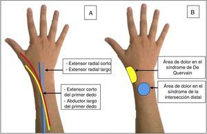 A) Trayecto anatómico de los tendones implicados en el síndrome de intersección distal. B) Localización del dolor en el síndrome de intersección distal y en la tendinitis de De Quervain.