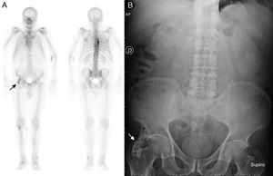 A) Gammagrafía ósea de cuerpo completo con 99mTc-HDP en planos anterior y posterior. B) Radiografía AP simple de abdomen.
