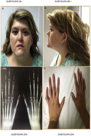 Fenotipo frontal (A), lateral (B), radiología de manos (C) y aracnodactilia (D). Puente nasal deprimido, hipoplasia facial, macrognatia, proptosis, pabellón auricular de baja implantación. Manos alargadas e hiperlaxitud. Aumento longitud de metacarpianos y falanges.