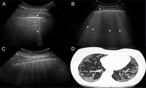 Exámenes de US que muestran diferentes cuadros de EPI basados en el número de lineas B. A. Solo hay una línea B (punta de flecha). B. Se distinguen 4 líneas B (puntas de flecha). Ambos casos presentan irregularidad pleural (flechas). C. Examen de US mostrando un espacio intercostal con 6 líneas B y neta irregularidad de la pleura en comparación con el cuadro TACAR de EPI (D).