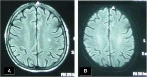 A female patient aged (27 years) and suffered from SS since (3 years). (A) FLAIR MRI shows a rather-defined single hyperintense signal lesion seen at deep periventricular white matter of the parietal regions with no comparable signal abnormality on DWI (B) suggesting late subacute to chronic ischemic lesions.