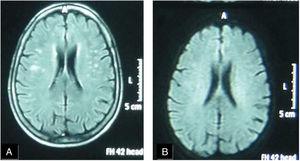A female patient aged (60 years) and suffered from SS since (4 years). (A) FLAIR MRI shows multiple rather-defined hyperintense signal foci seen at deep periventricular white matter of both parietal regions with no comparable signal abnormality on DWI (B) suggesting late subacute to chronic ischemic lesions.