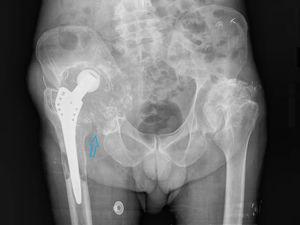 Radiografía simple de cadera bilateral en proyección AP con importantes signos de resorción ósea de la articulación coxofemoral derecha (flecha).
