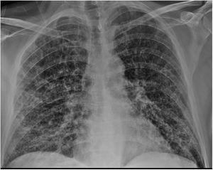 Radiografía de tórax al ingreso donde se objetivan infiltrados alveolares bilaterales con patrón en vidrio deslustrado.