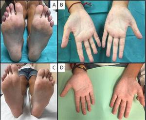 Isquemia digital al comienzo y evolución tras tratamiento. A y B) Isquemia digital y lesiones vasculíticas en palmas de las manos al comienzo. C y D) Mejoría tras un mes de tratamiento.