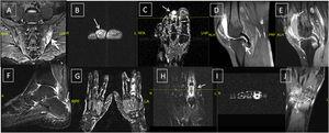 Undifferentiated and differentiated SpA with axial and peripheral joints involvement; (A) axial STIR MRI showing bilateral Sacroiliitis with bone marrow oedema (BME), more prominent on the left side; (B, C) axial and coronal T1 post-contrast fat suppressed MRI of the left foot showing tenosynovitis of the DIP joint of the left 2nd toe with significant enhancement signifying underlying dactylitis; (D, E) reactive arthritis: sagittal T2 fat suppressed and T1 post-contrast fat suppressed MRI of the knee showing peri-entheseal bone marrow oedema around the tibial attachment of the PCL with joint effusion and enhancing synovium suggestive of synovitis; (F) undifferentiated SpA: sagittal STIR MRI of the ankle with posterior calcaneal erosions and mild oedema and thickening of the planter fascia; undifferentiated SpA: (G) coronal T1 post-contrast fat suppressed MRI of both hands with diffuse enhancement and inflammatory changes of the right middle finger (dactylitis); (H, I): undifferentiated SpA: coronal and axial T1 post-contrast fat suppressed MRI of the left hand with diffuse enhancement and tenosynovitis of the left index finger. Undifferentiated SpA (mono arthritis pattern): (J) coronal T1 post-contrast fat suppressed MRI of the left wrist with diffuse inter-carpal & CMC joint enhancement.