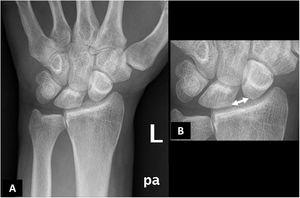 Radiografía simple posteroanterior de muñeca izquierda (A) con detalle magnificado (B). Se objetiva una diástasis significativa entre el hueso semilunar y escafoides del carpo (flecha de doble cabeza), que en la medición manual fue de 3,5mm. Además, se aprecia una subluxación rotatoria del hueso escafoides (B), que es un indicador indirecto de lesión del ligamento escafosemilunar, aunque es visible en otras lesiones de diferentes estabilizadores de la muñeca.