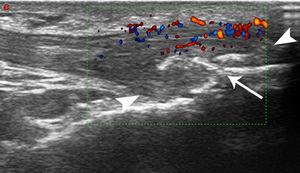 Patellar tendon enthesopathic changes in patient with metabolic syndrome. Anterior longitudinal scan over the distal enthesis of patellar tendon, linear 6–18MHz probe. The distal enthesis of the patellar tendon (between arrowheads) is markedly thickened and hypoechoic, with gross enthesophytosis (arrow). Power Doppler analysis (within the color box) shows abundant neovascularisation in the distal third of the tendon. All the abnormalities spread beyond the real enthesis toward the body of the tendon.