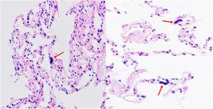 Hematoxylin–eosin stain: alveolar megakaryocytes (naked nuclei) (H–E ×400).