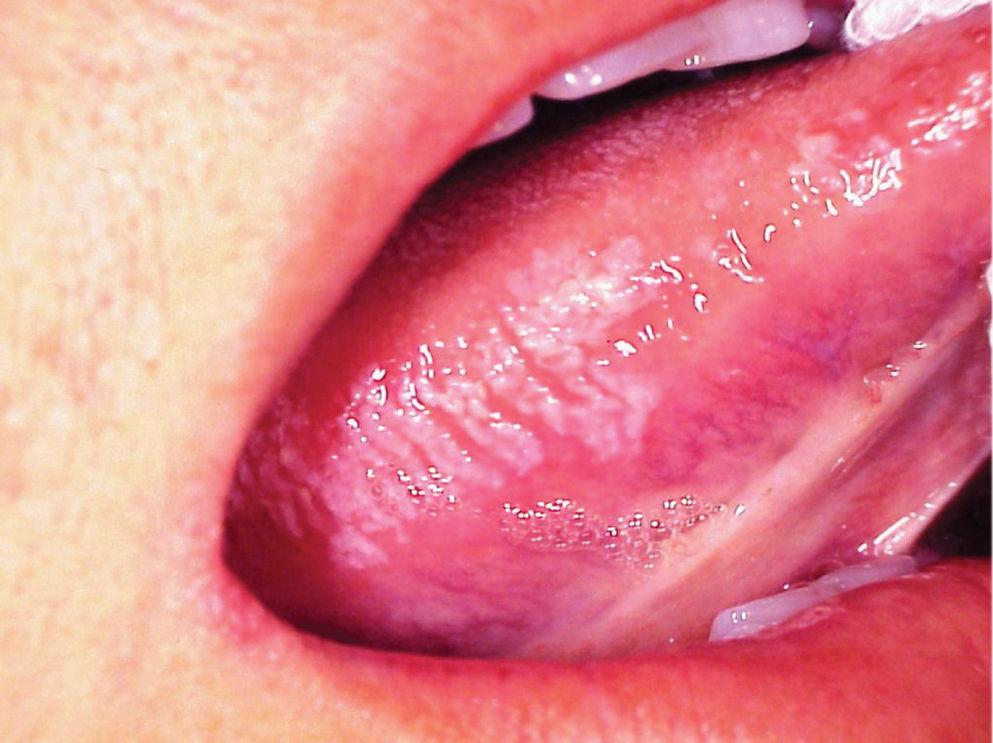 hiv tongue lesions