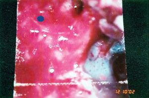 Transoperative picture of modified radical mastoidectomy showing intact TM and CEAC affecting the mastoid.