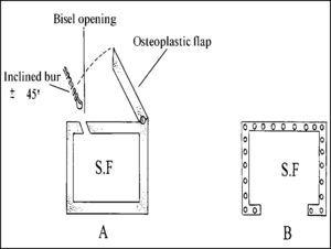 Illustration of the drill's position to make the holes and develop the osteoplastic flap with wedge borders.