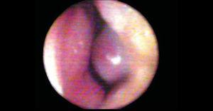 Photography of nasal valve in baseline conditions.