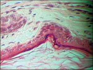 Epidermoid cyst – Innermost corneal layer (lower figure) followed by granulated, squamous and basal layers.