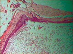 Epidermoid cyst – cystic structure coated by a stratified squamous epithelium. Innermost corneal layer (lower figure) with keratin desquamation in lamellas followed by granulated layer and, outermost squamous and basal layers.