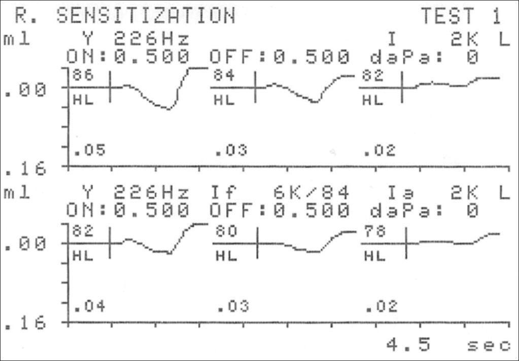 A diagram for plotting findings for tympanometry and acoustic reflexes