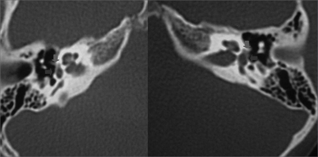 Stapes, Radiology Reference Article