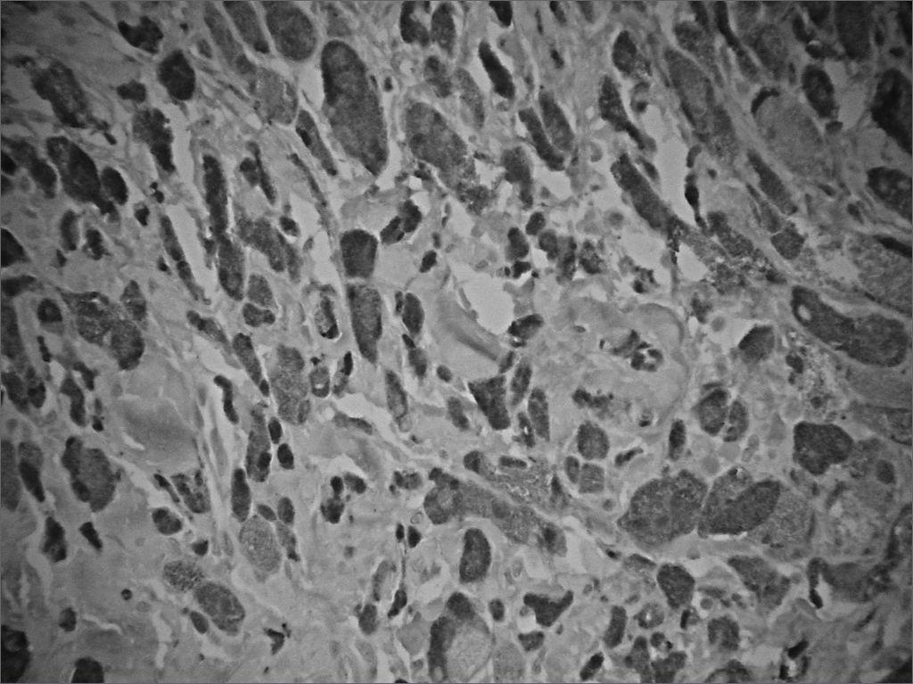 granular cell tumor larynx
