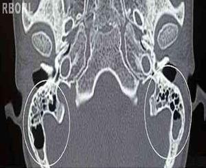 Mastoid computed tomography, cross-sectional view. Within the clear circles, a bilateral partial clouding of mastoid cells is observed.