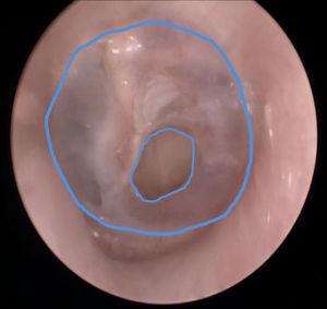 Image obtained through circumscription of the tympanic membrane and of its perforation.