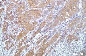 Cytoplasmic staining of vascular endothelial growth factor in squamous cell carcinoma (200×).