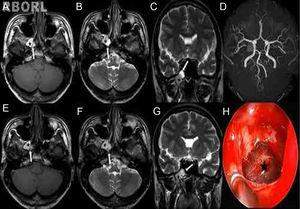 (A–D) The muocele is composed of two separate parts. T1-weighted magnetic resonance imaging (MRI) scan (A, axial) shows a hyperintense part (black star: high protein content) and a mildly hyperintense part (white arrow: high water content). T2-weighted MRI scans (B, axial; C, coronal) shows a hypointense part centrally, with a surrounding rim of hyperintense mucosa (black star) and a part of a high signal. MRA scan (D) shows normal arterial vasculature and a mucocele. (E–G) Six months later, brain MRI was re-evaluated. It showed no changes in size, but minimal changes in signal intensity of the lesion. The T2-weighted signal is lower than expected in the part of high water content (white arrow), indicating the increase of protein within the mucocele. (H) After wide sphenoidotomy, the blackish cystic mass (black star) was found and completely removed by endoscopic surgery.