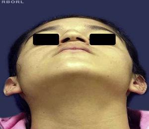 Preoperative nasal base picture.