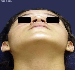 Postoperative nasal base picture.