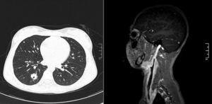 Left, Cross-Sectional Computed Tomography showing pulmonary microabscesses. Right, Post-contrast Sagittal T1-weighted Magnetic Ressonance Angiography, showing the Right Internal Jugular Vein filling failure.