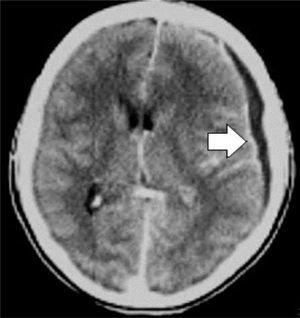 Axial CT scan showing subdural empyema.