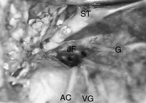 Right jugular foramen (JF) after internal jugular vein remotion, accessory nerve (AC), glossopharyngeal nerve (G), vagus nerve (VG), styloid process (ST).