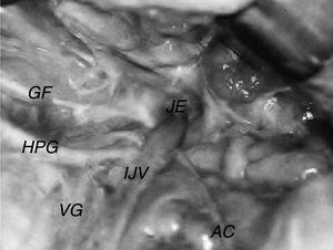 Left accessory nerve (AC) crossing posteriorly to the internal jugular vein (IJV). JF, jugular foramen; G, glossopharyngeal nerve; HPG, hypoglossal nerve; VG, vagus nerve.