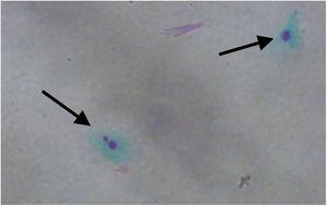 Micronuclei (left arrow) and normal nucleus (right arrow) in oral exfoliated epithelial cells (×400).