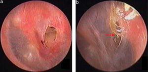 The spontaneous healing of traumatic TMP: 3 days after perforation (a), crust healing (b). Red arrows indicated crust.