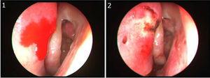 (1) Endoscopic view of left nasal cavity. Bleeding at Superior portion of nasal septum, above the axilla of middle turbinate (S-point). (2) S-point cauterization was performed.