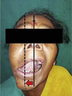 Ipsilateral deviation of mandible on mouth opening (continuous line – actual midline, dotted line – midline of mandible).