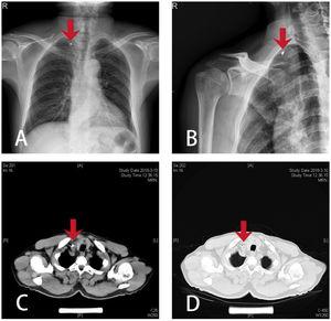 Preoperative imaging: (A) frontal chest radiograph; (B) tangential clavicular joint radiograph; (C) chest CT plain scan (mediastinal window); (D) chest CT plain scan (pulmonary window); (red arrow pointing at the foreign object).