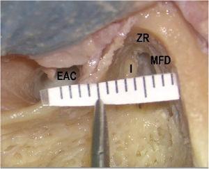 Complete mastoidectomy on the left temporal bone. Extended dissection in the zygomatic root (ZR) and posterior bony wall of the external auditory canal (EAC). Middle fossa dural plate (MFD) was exposed by drilling the bone over it (I, Incus).