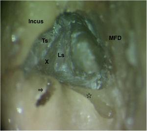 Closer view of the labyrinthine segment (Ls) after bone removal between tympanic segment (Ts), ampullary ends of the lateral semicircular canal (arrow) and superior semicircular canal (star), and MFD. For better demonstration membranous labyrinths of both semicircular canals were removed. X, Vertical crest at the fundus of the internal acoustic canal.