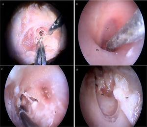 Steps performed in the endoscopic dissection. A, CC resection; B, macroscopic evaluation of BC and TM; C, LC drilling; D, preparation of the TMF and visualization of the ME. CM, Cartilaginous canal; BM, Bone canal; TM, Tympanic membrane; LC, Lower portion of the canal; P, Posterior canal; ME, Middle ear; TMF, Tympanomeatal flap.