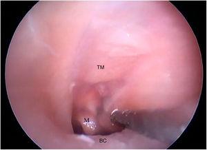 Bone canal and goat ear tympanic membrane. TM, Tympanic membrane; M, Malleus; BC, Bone canal.